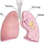 Battling Lung Cancer: Understanding Types, Symptoms, Causes, and Treatment